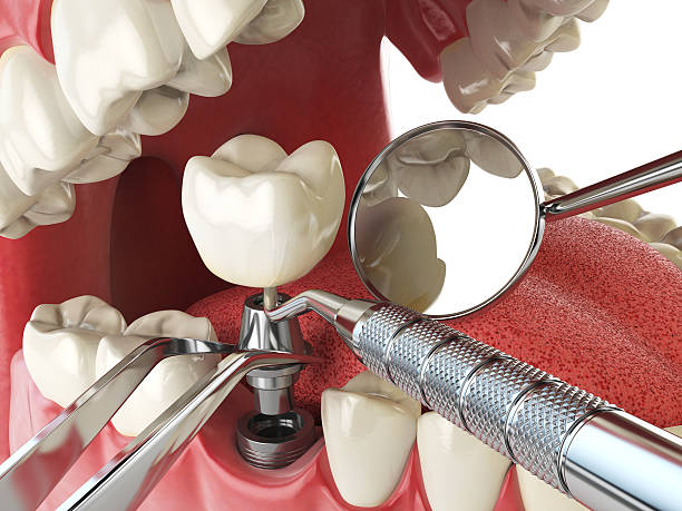 Best Emergency Root Canal Treatment in Pell City, AL